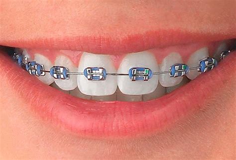 tipos de brackets metalicos mini|tipos de brackets ortodoncia.